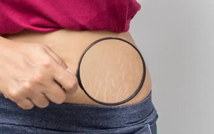 Stretch Marks: Common Causes and how to get rid of them | Skin Decor