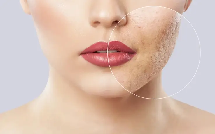 Tips by Dr Monica Chahar to prevent Acne Scars | Skin Decor
