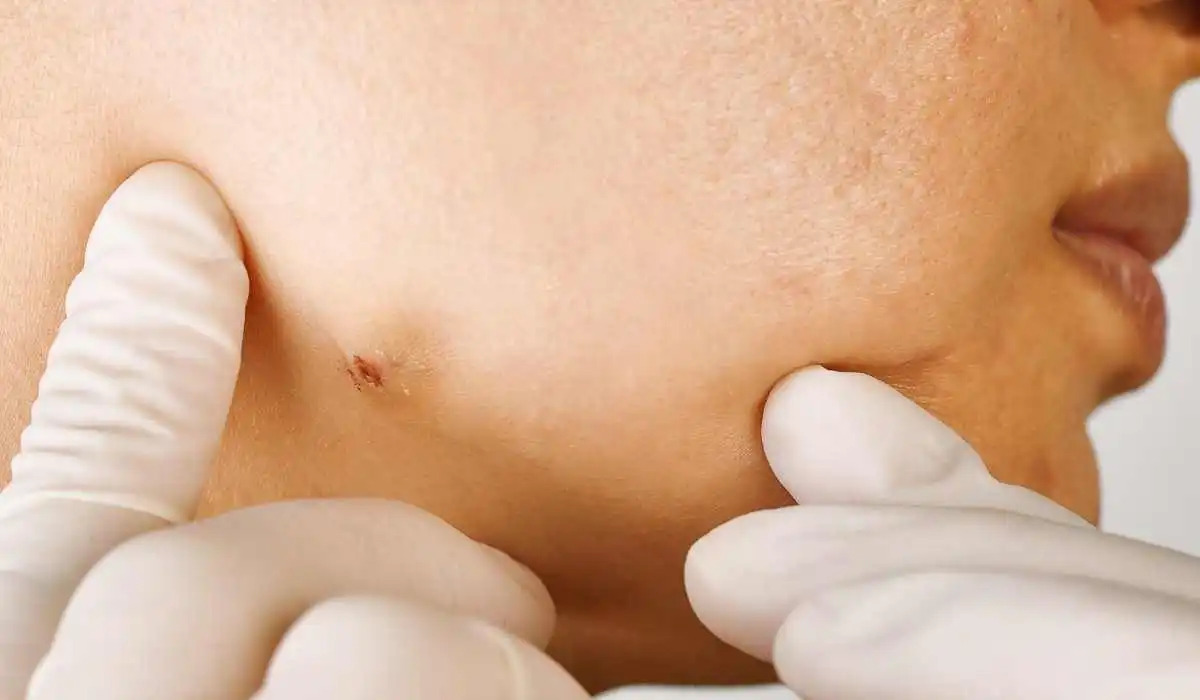 Skin Acne in Summer: Insights from a Dermatologist in Delhi