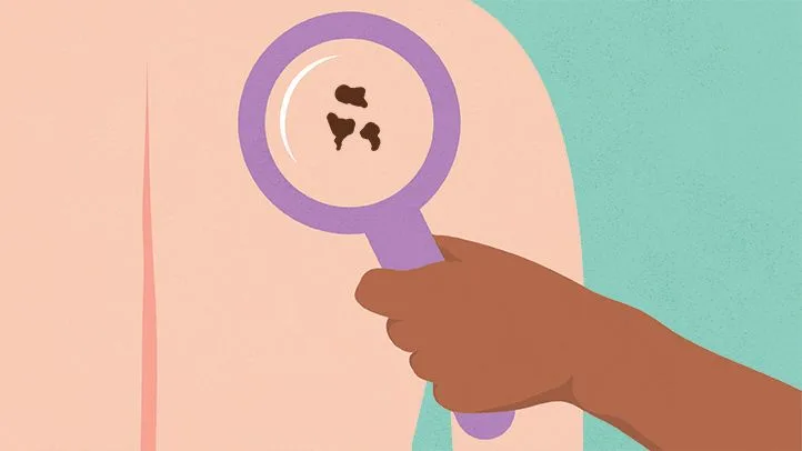 Skin cancer symptoms and treatment | Dermatologist in Delhi
