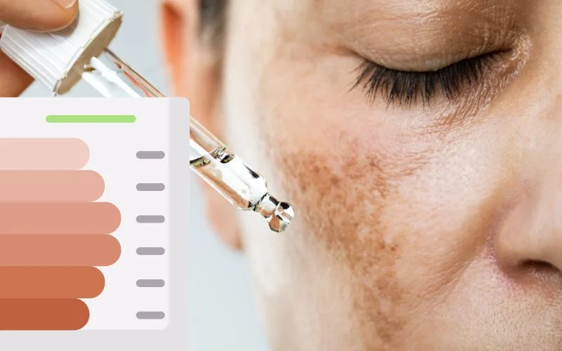 How to Reduce Melanin in Skin Permanently? Skin doctor in Delhi
