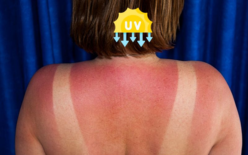 How to Treat Sunburn Explained by a Skin Specialist in Delhi?