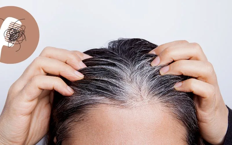 Causes of Hair Thinning and Treatment in Delhi