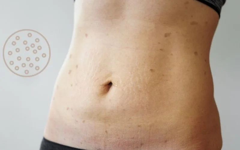 How to cure lichen planus? Skin doctor in Delhi explains