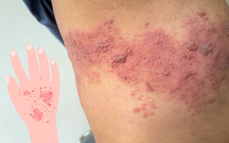 Skin Doctor Explains Shingles Rash Disease and its Treatment in Delhi