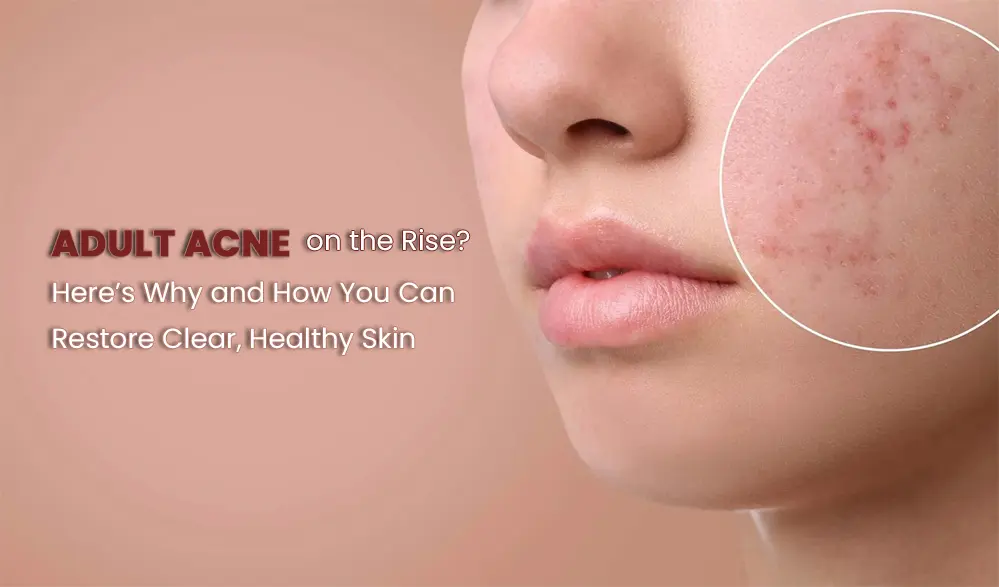 Adult Acne on the Rise? Here's why – and How You Can Restore Clear, Healthy Skin