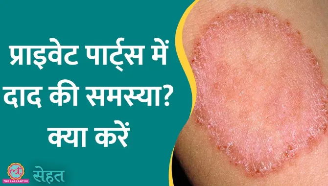Ringworm यानी दाद होना आम बात है, क्या ये एक इंसान से दूसरे इंसान में फैल सकता है?