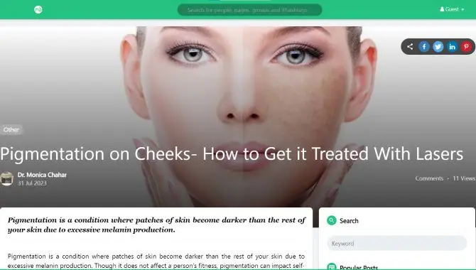 Pigmentation on Cheeks- How to Get it Treated With Lasers