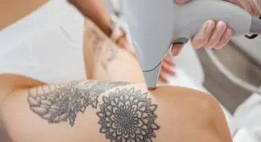 Tattoo Removal