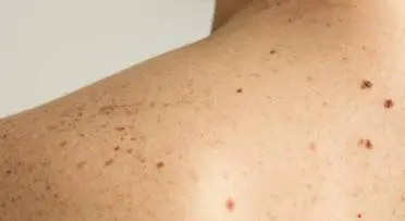 Warts / Skin Tags Removal