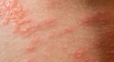 Urticaria Treatment