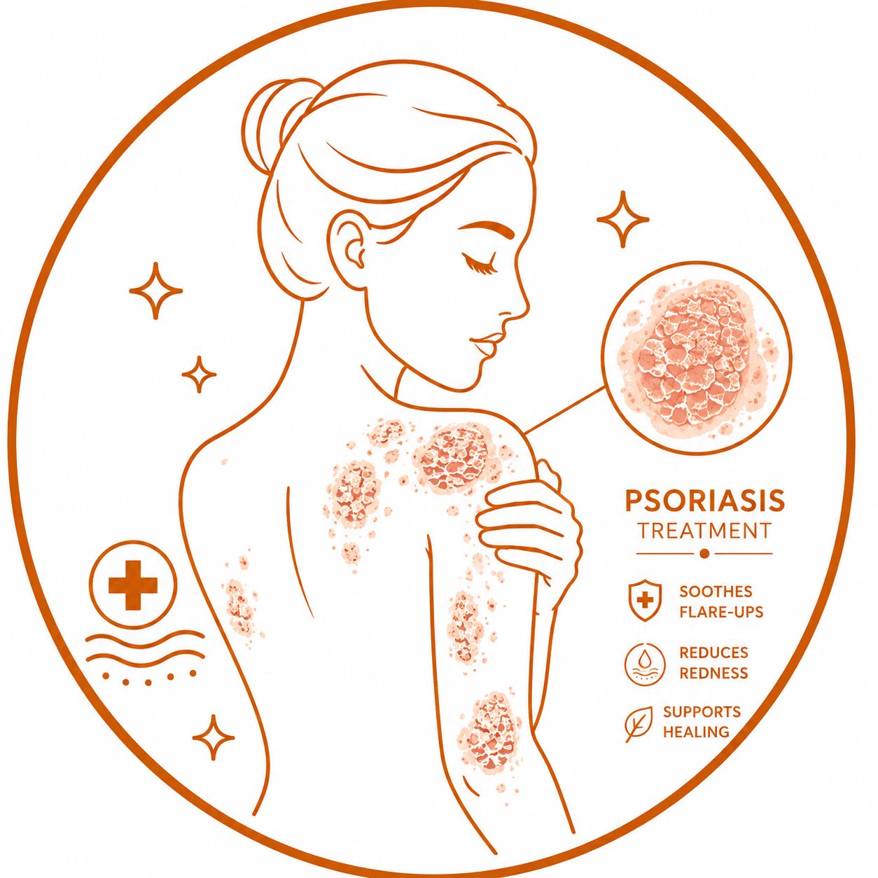 Psoriasis