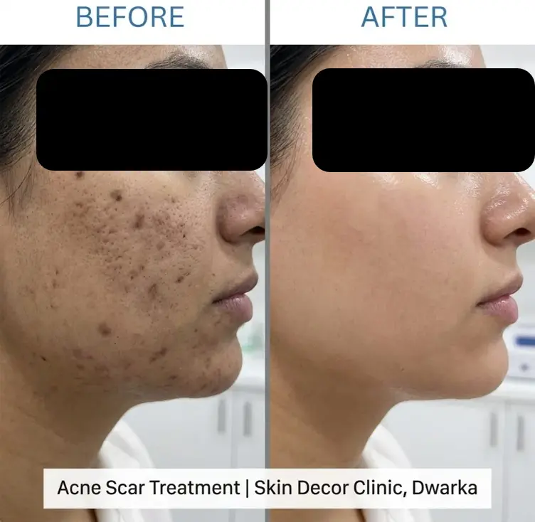 Acne Scar Treatment Before After Results — Skin Decor Clinic Dwarka