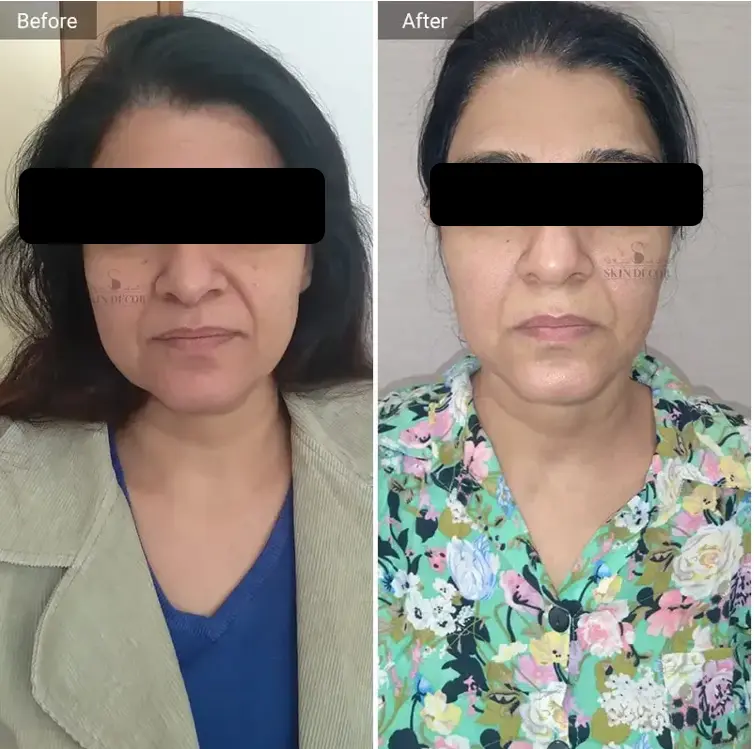 Face Rejuvenation Before After — Skin Decor Dermatology Clinic Dwarka