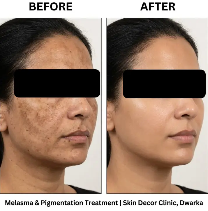 Melasma and Pigmentation Treatment Before After — Skin Decor Clinic Dwarka