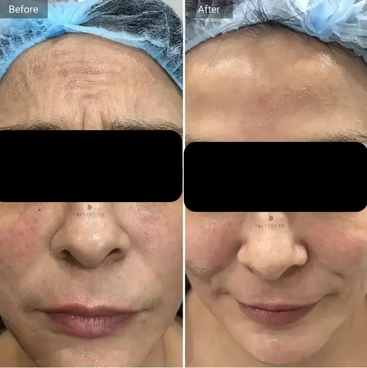 Anti-Wrinkle Botox Injection Results — Skin Decor Clinic Dwarka