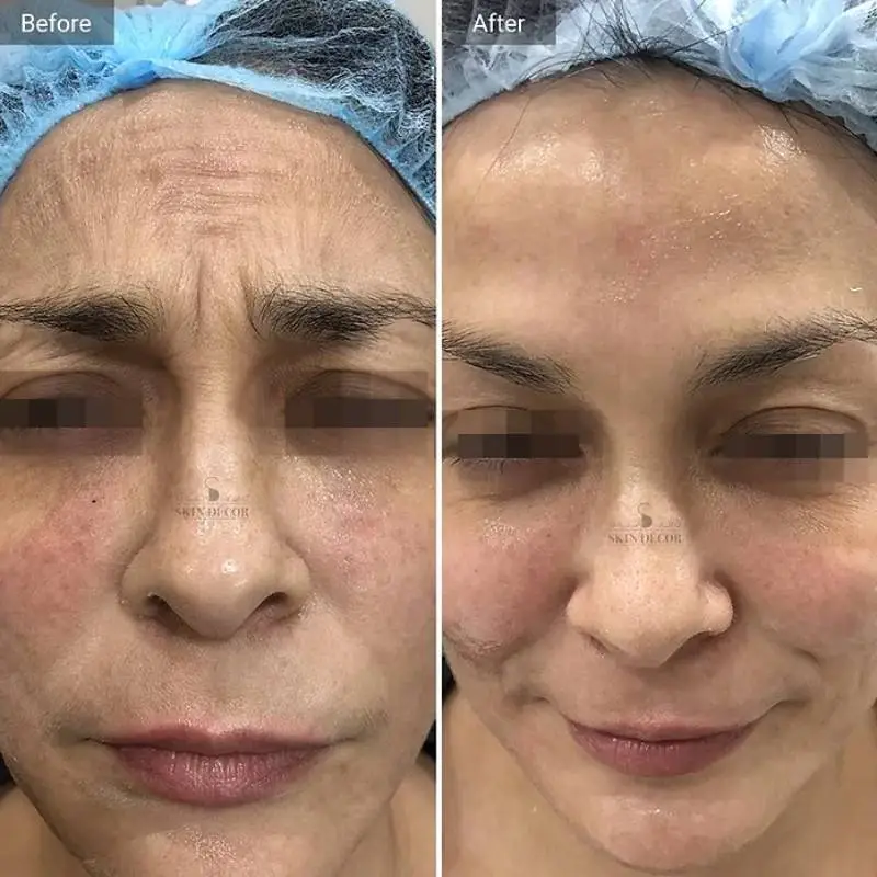 Anti Wrinkle Injection