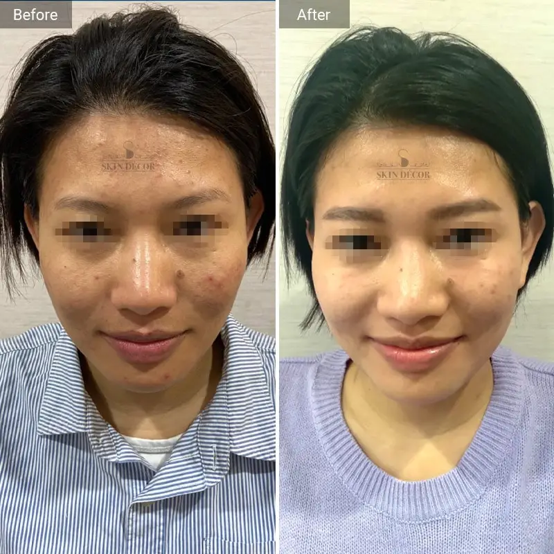 Face Rejuvenation