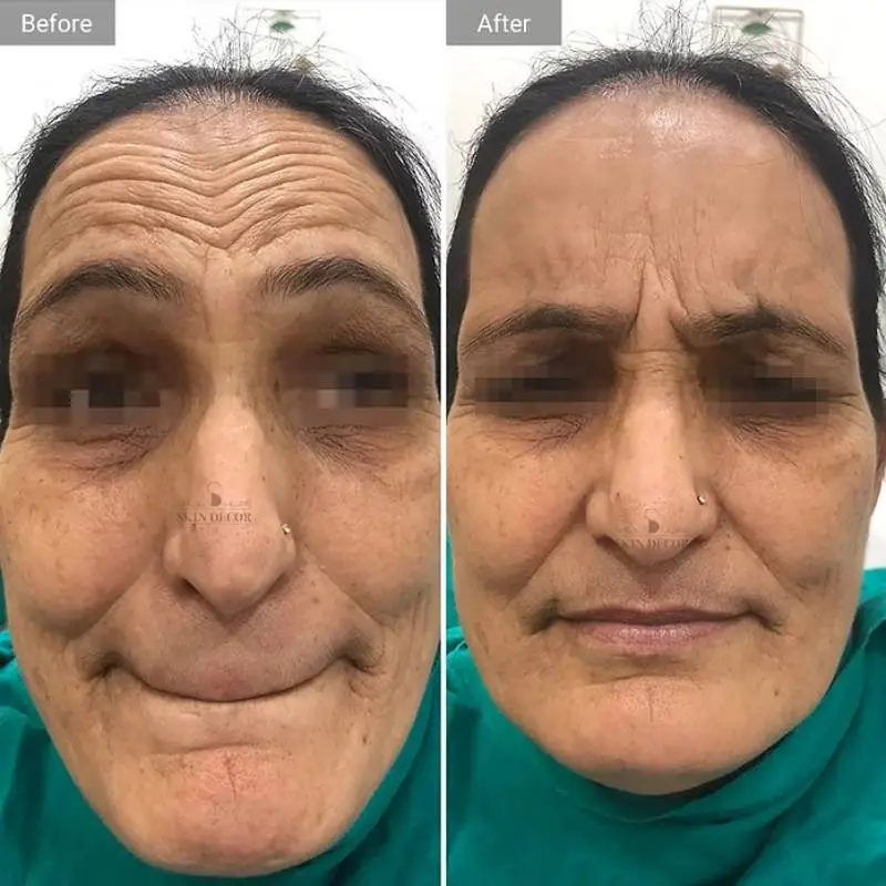 Face Rejuvenation