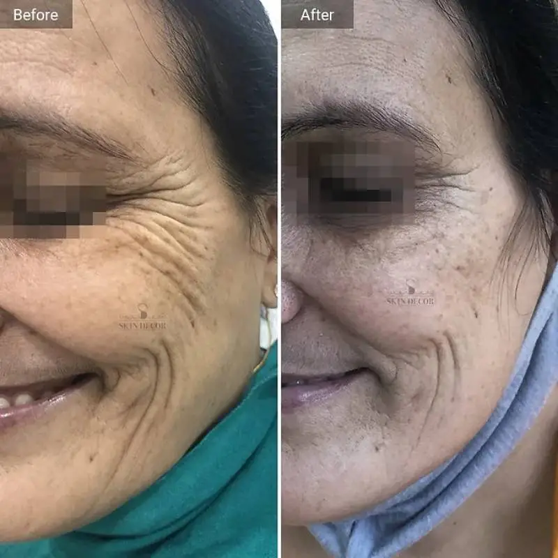 Anti Wrinkle Injection