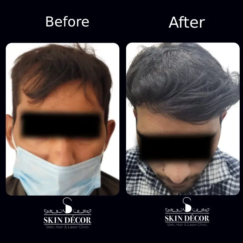 Hair Transplant