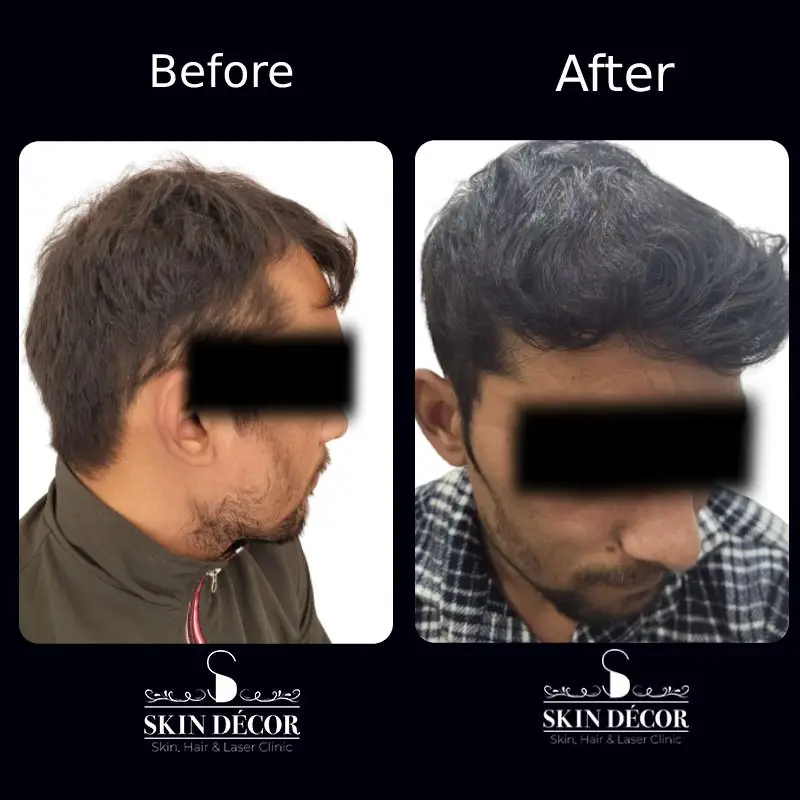 Hair Transplant