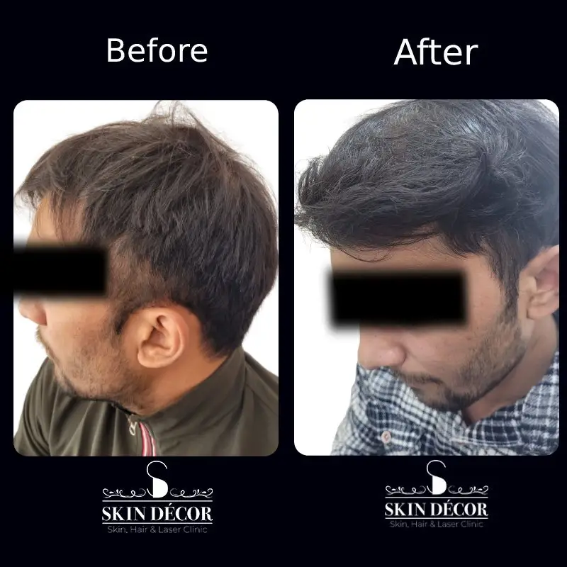 Hair Transplant