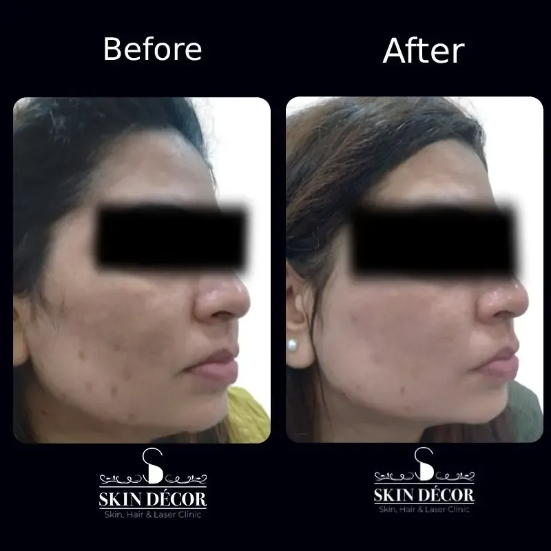 Skin Decor Clinical Transformation Result