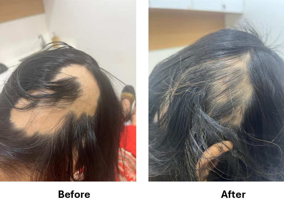 Alopecia (Hair Loss) Result #2