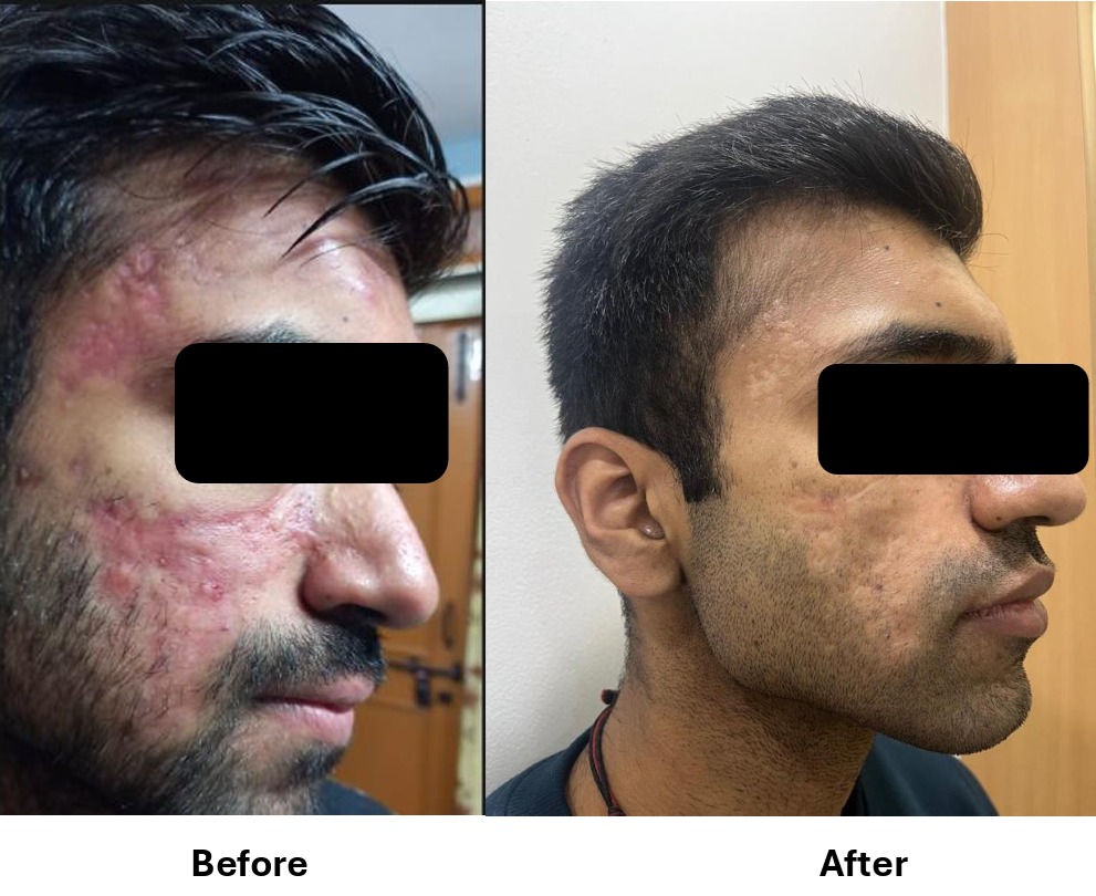 Acne Scar Treatment Result #13