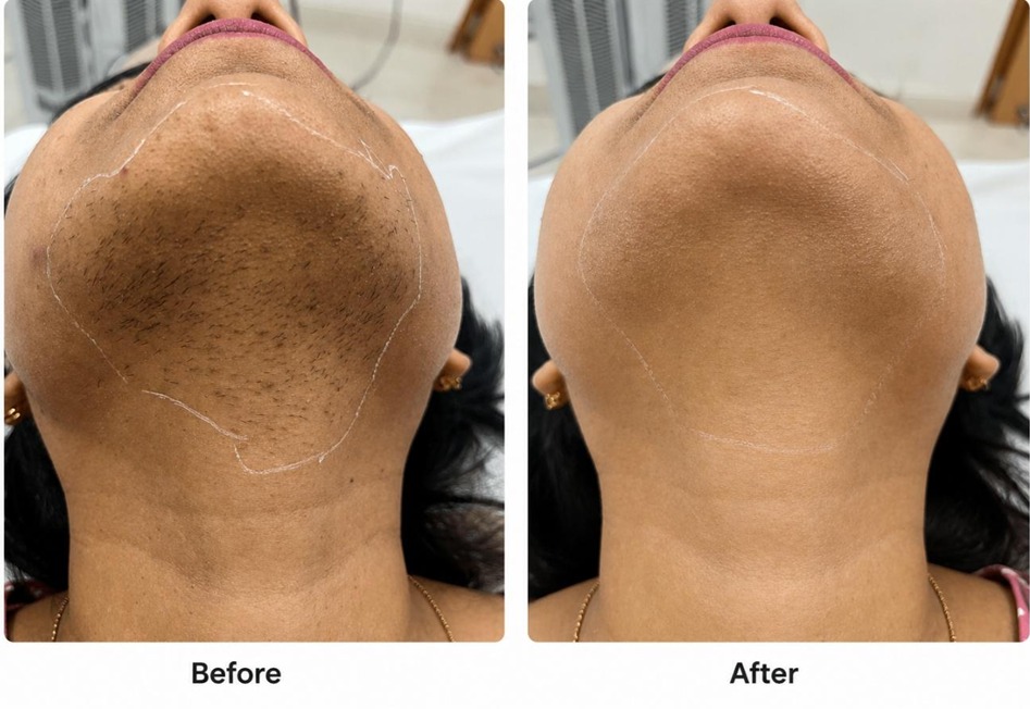 Laser Hair Removal Result #9