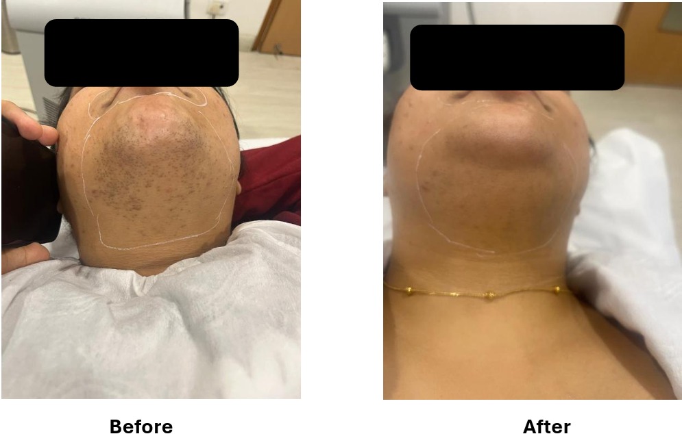 Laser Hair Removal Result #10
