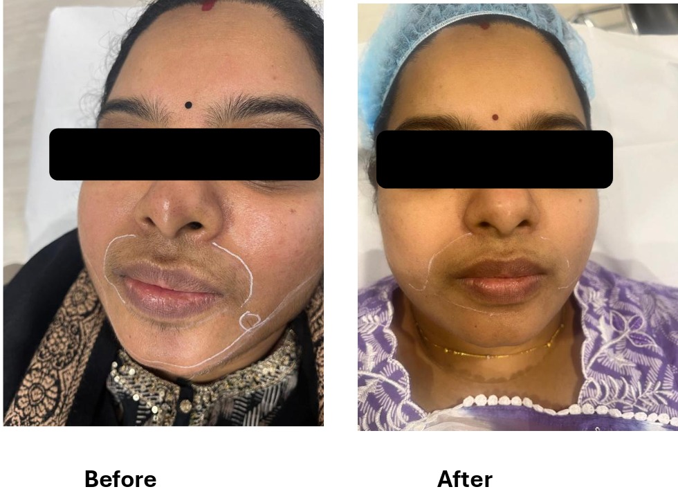 Laser Hair Removal Result #11