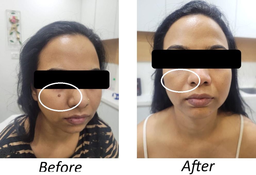 Mole Removal Result #1