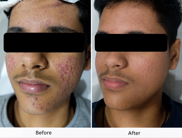 Acne Scar Treatment Result #14