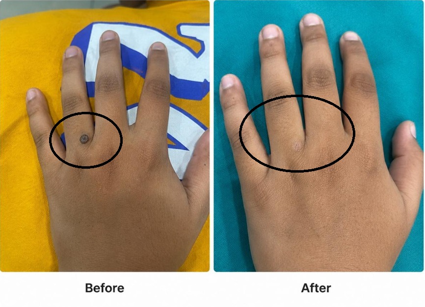 Wart  Removal Result #1