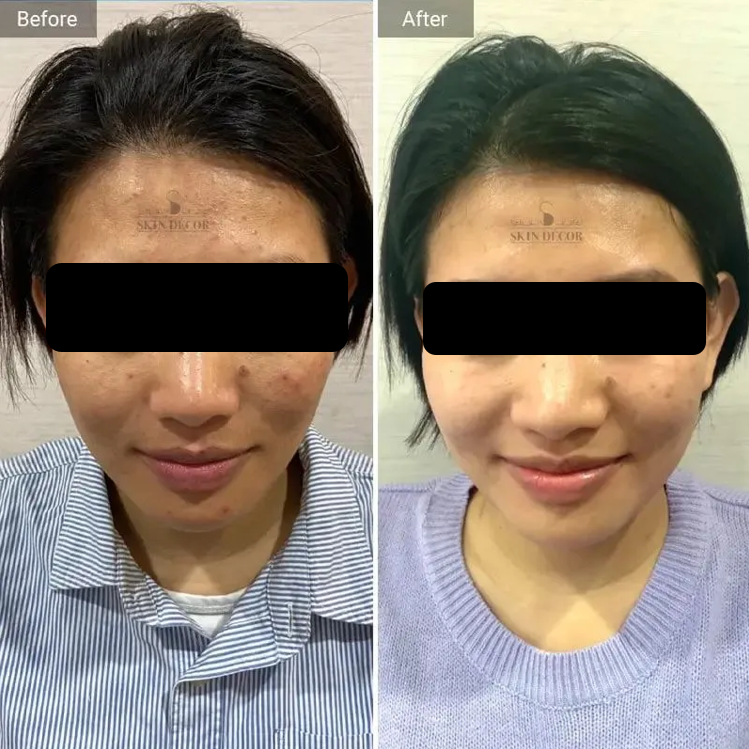 Face Rejuvenation Result #4