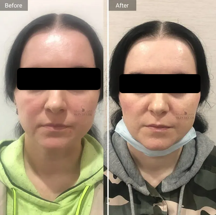 Cheek Lift Filler Result #1