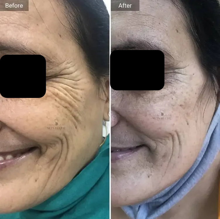 Anti-Wrinkle Injection Result #1