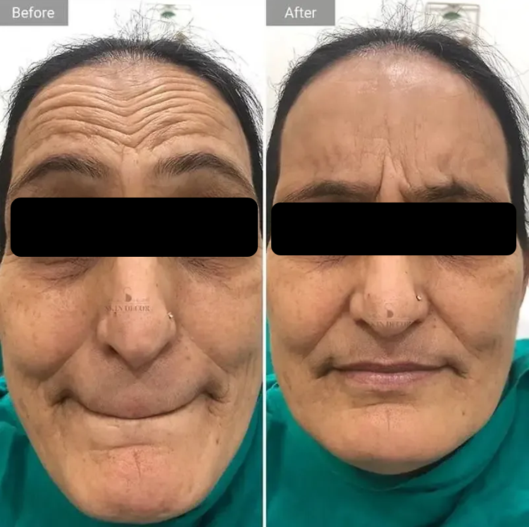 Anti-Wrinkle Injection Result #2