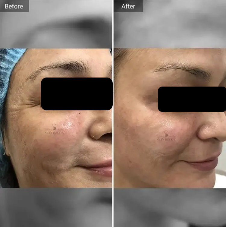 Anti-Wrinkle Injection Result #3