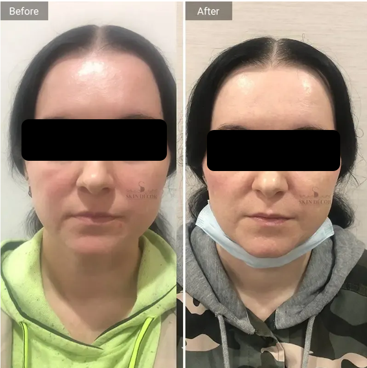 Skin Decor Clinical Transformation Result