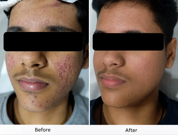 Skin Decor Clinical Transformation Result