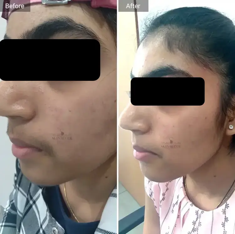 Skin Decor Clinical Transformation Result