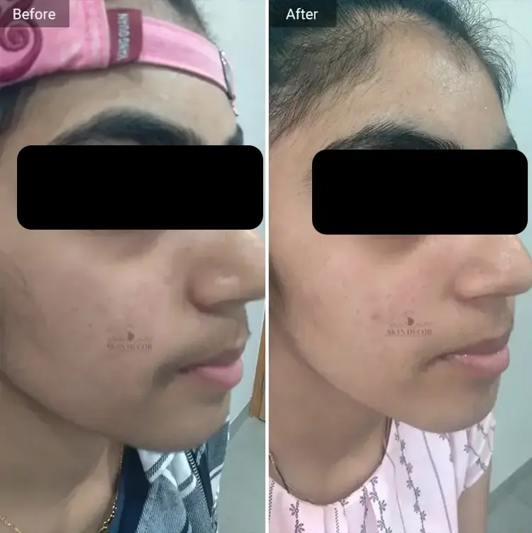 Laser Hair Removal Result #3