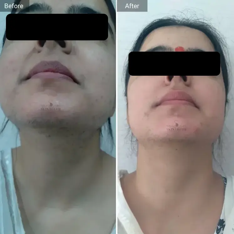 Laser Hair Removal Result #4