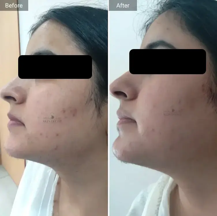 Laser Hair Removal Result #5