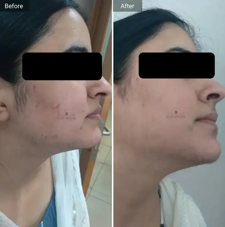 Laser Hair Removal Result #6