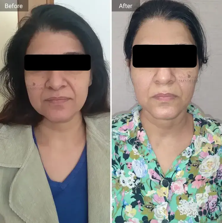 Face Rejuvenation Result #5