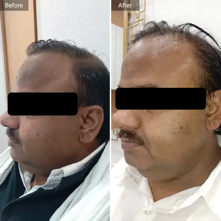 Face Rejuvenation Result #1